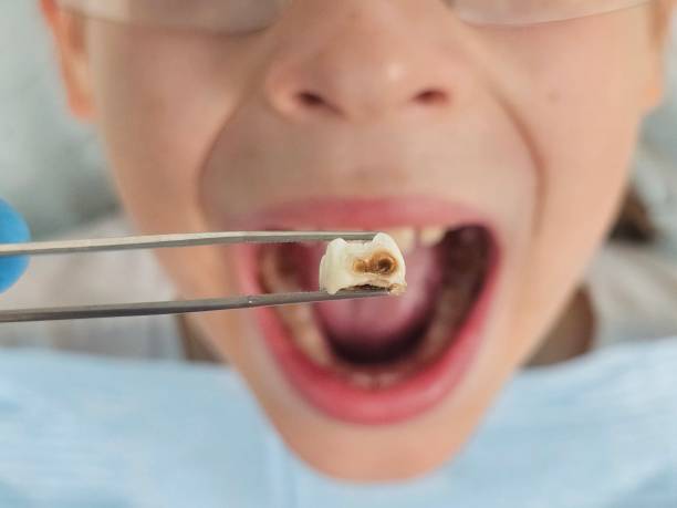 Best Emergency Tooth Extraction in Middlesex, NC